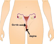 cervical screening
